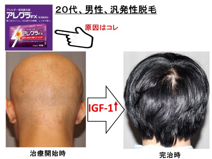 円形脱毛症　病院